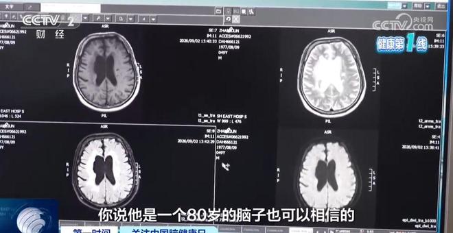 上海一49岁男子确诊血管性痴呆，脑萎缩程度堪比80岁老人